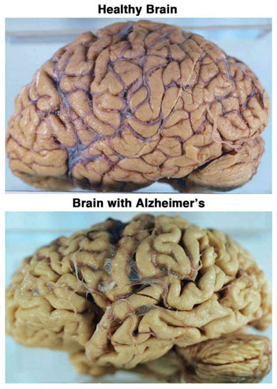 AlzhBrainPrint e